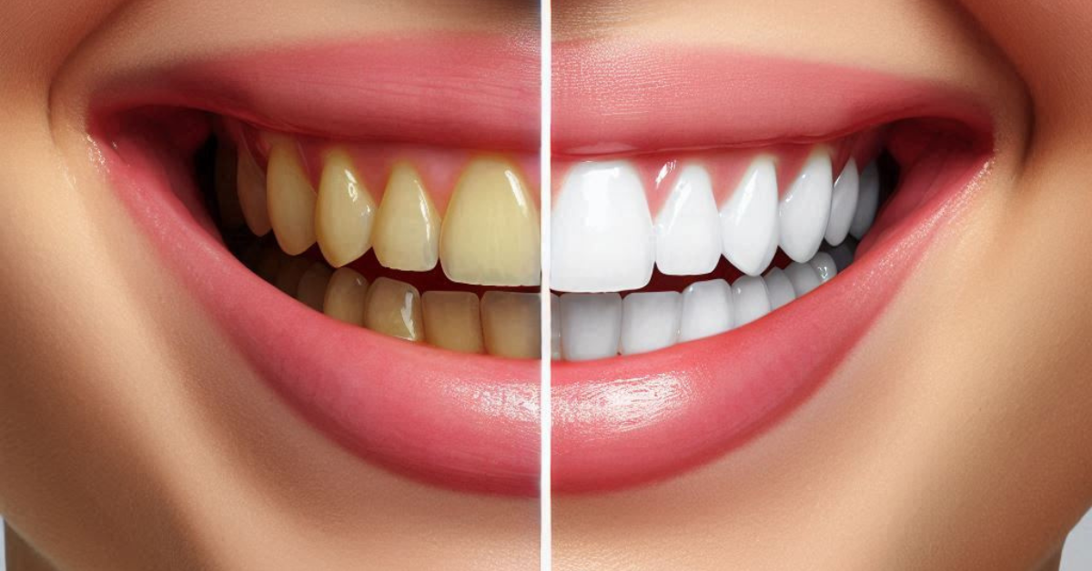  The Benefits of Teeth Whitening: Achieve a Brighter Smile