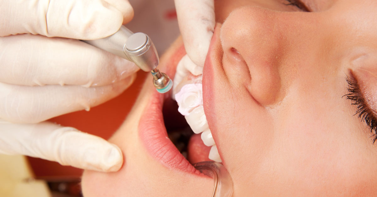 How Dental Bonding Can Help Fix Chipped, Cracked, or Discolored Teeth