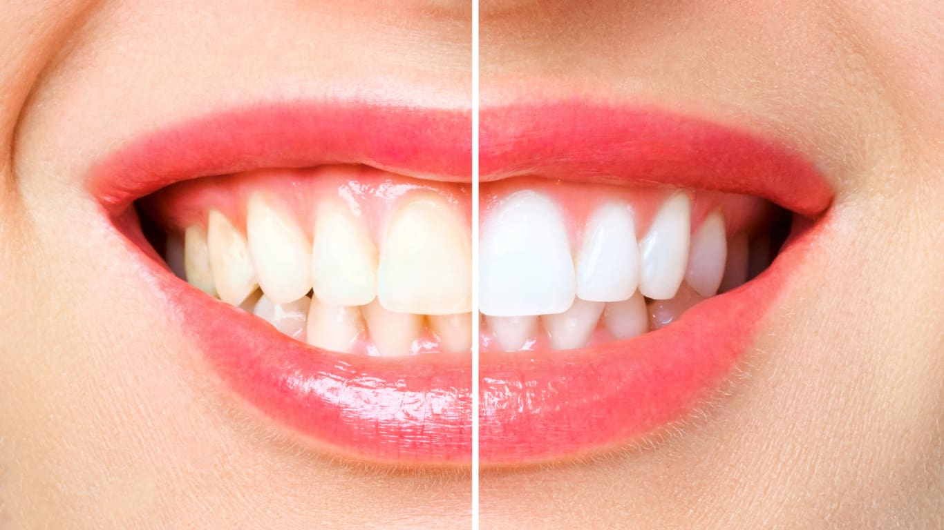 Teeth Whitening Kottayam
