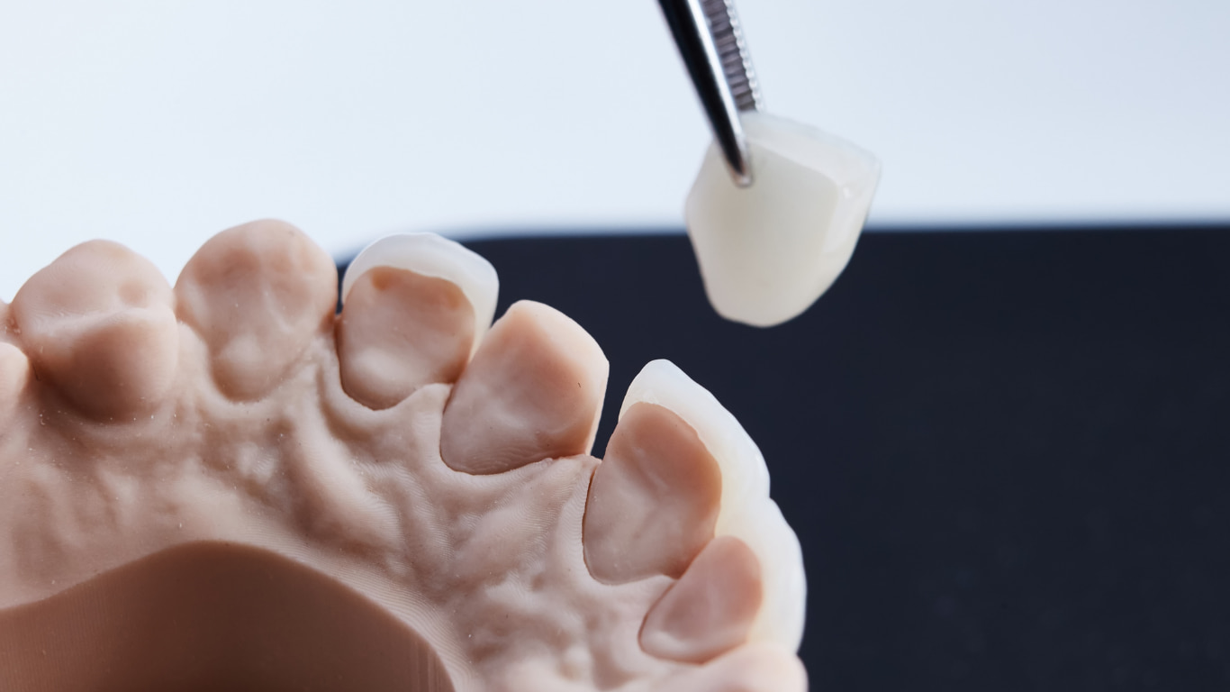 Dental Veeners Kottayam