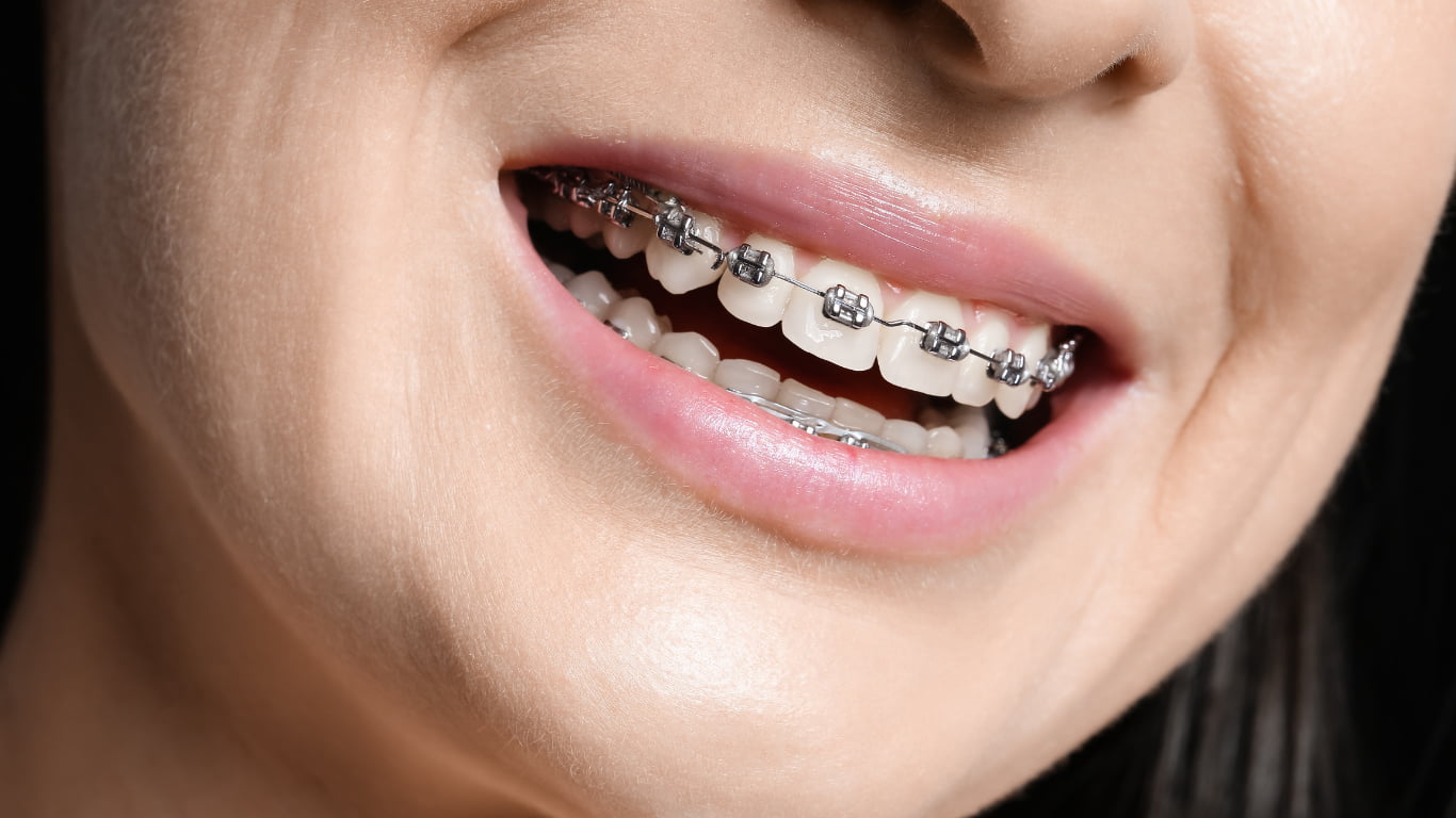orthodontics braces Kottayam
