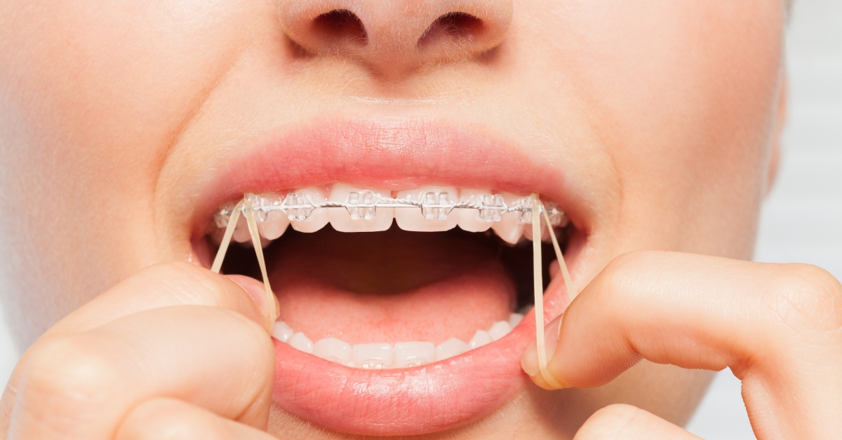 Orthodontics for Adults: It’s Never Too Late for a Perfect Smile