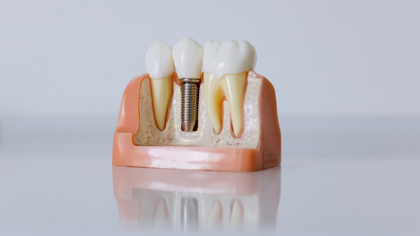 Dental Implants In Kottayam