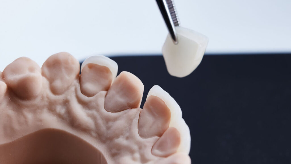 Dental veeners Kottayam
