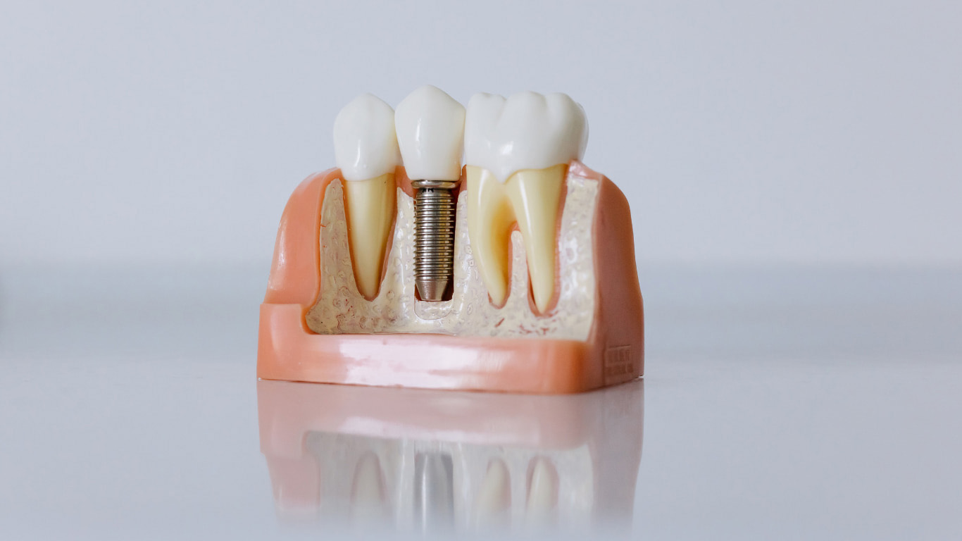 Dental implants in Kottayam