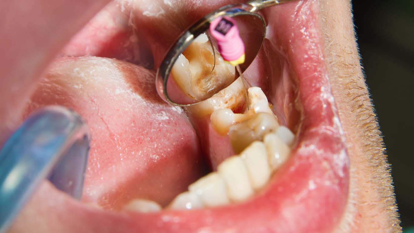 Root canal treatments in Kottayam