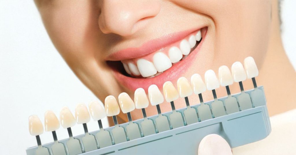Everything You Need to Know About Dental Veneers