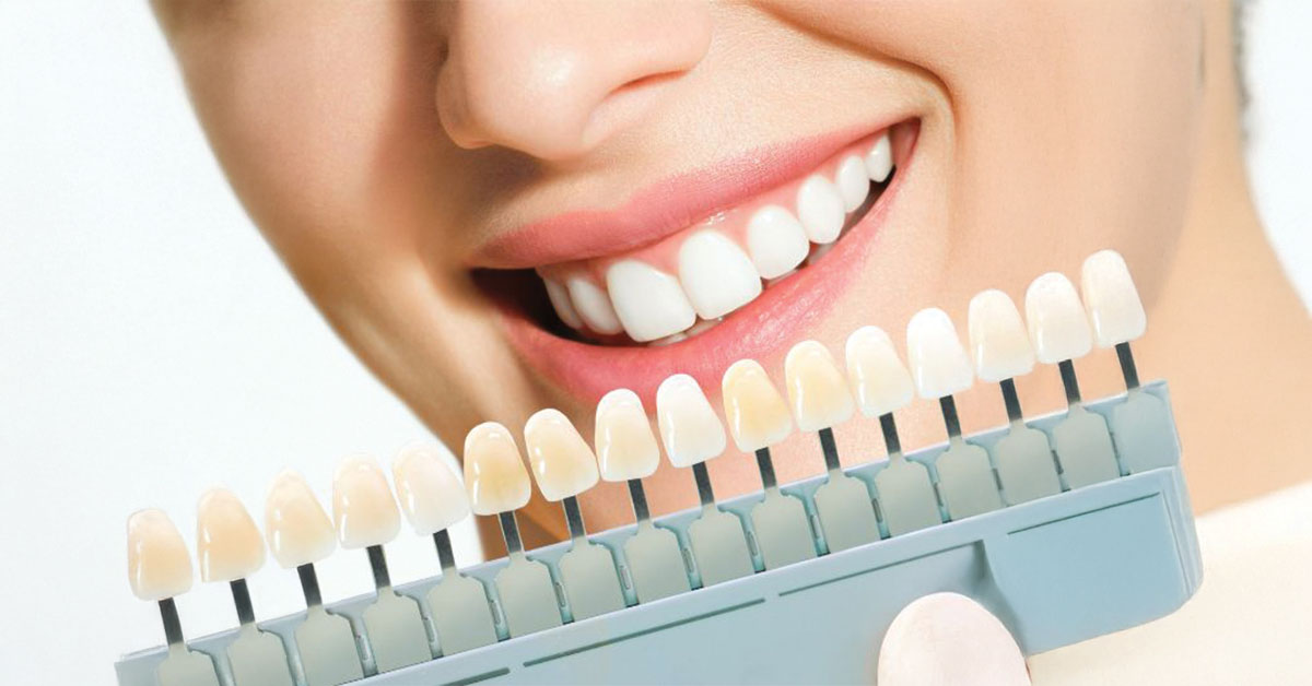 Everything You Need to Know About Dental Veneers
