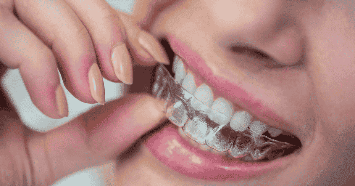 Do Clear Aligners Affect Speech? What Patients Should Know